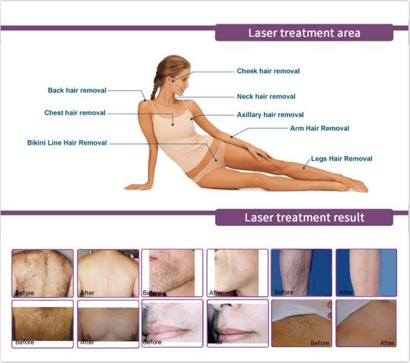 laser hair removal machine