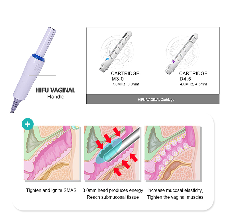 treatment hifu vagina