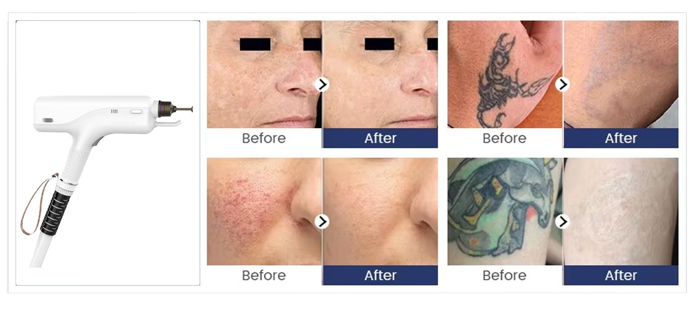 QM-120-diode-laser-nd-yag-laser-(11)