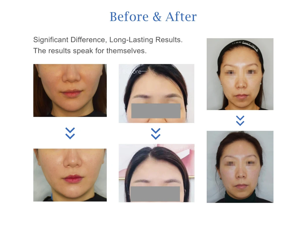 CE Approved Anti-Aging Plla Poly-L-Lactic Acid Dermal Filler for Butt