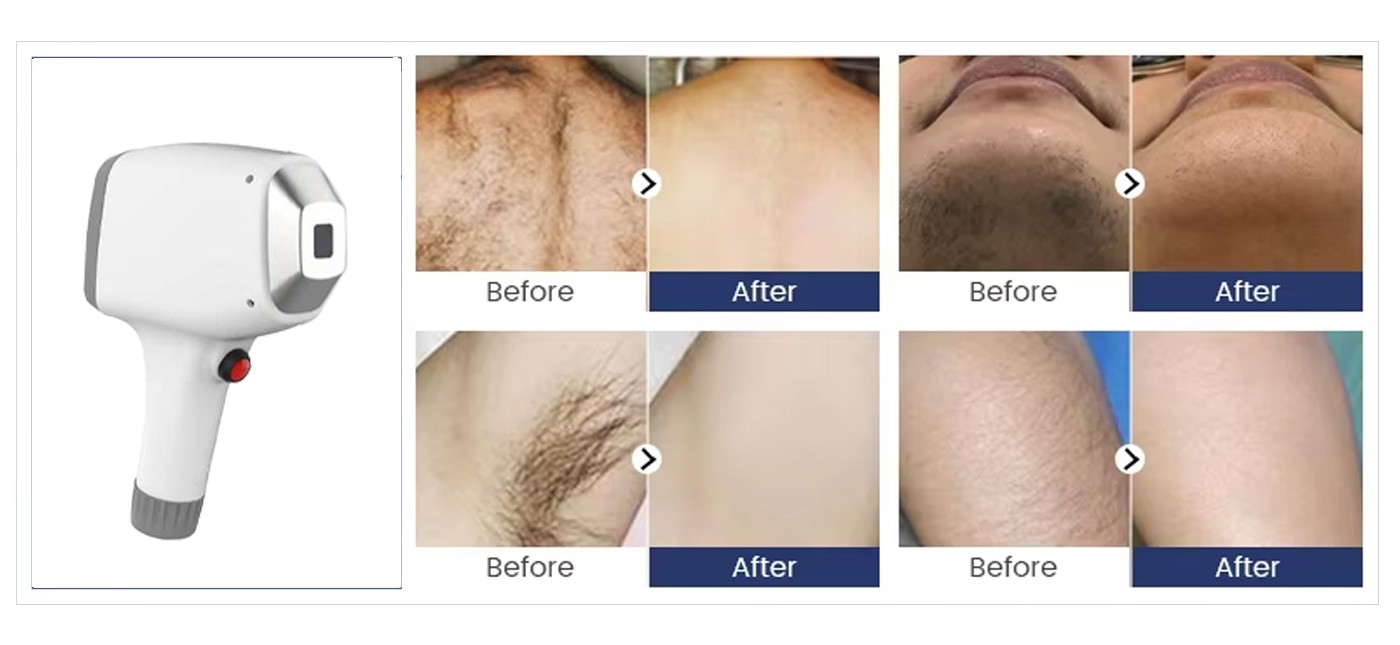 QM-120-diode-laser-nd-yag-laser-(12)