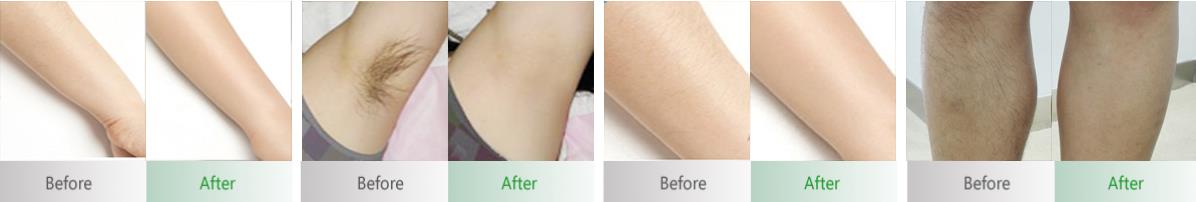 Before&After Hair removal