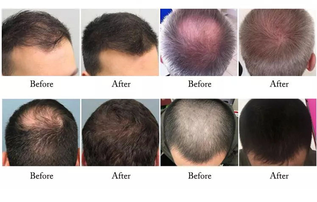 New 650nm Diode Laser Hair Regrowth for Doctors and Beauticians Use