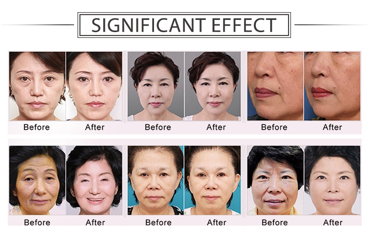 face lifting machine before after