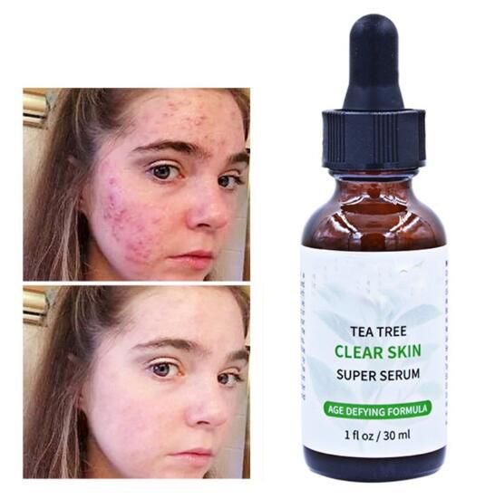 30 ml para reparar el acné del árbol del té para la cara, tratamiento de la cicatriz del acné, control de aceite, esencia, marcas Anti acné para la piel sensible cuidado