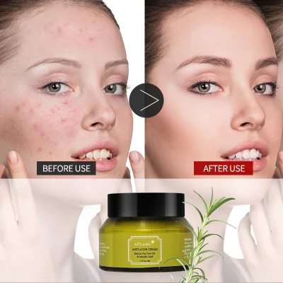 Private Label Best Natural Organic Tea Tree Oil Anti Pimples Remover Acne Treatment Cream Wholesale OEM ODM Softening Face Cream