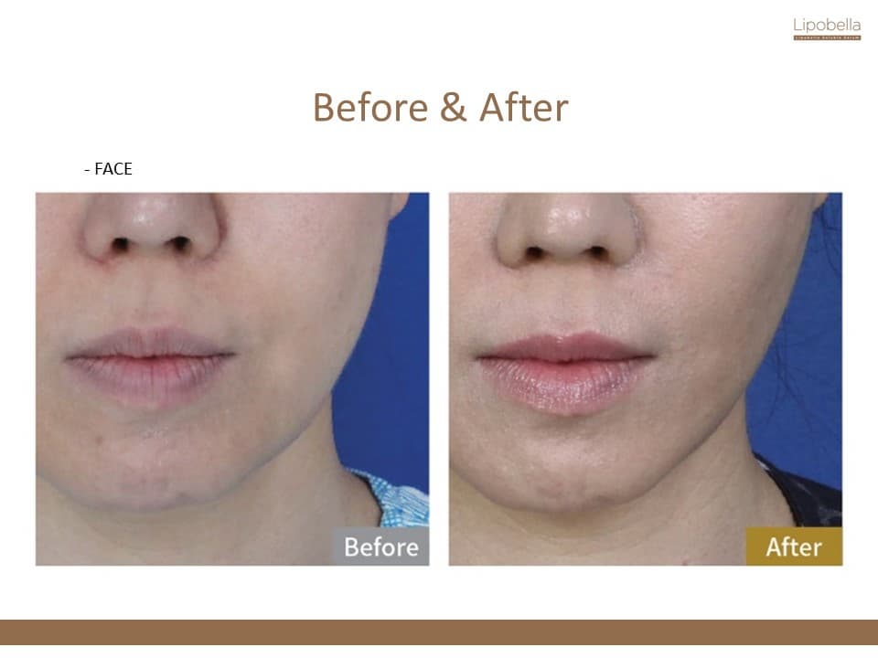 Lipobella Soluble Serum (fat desolve, fat burner, lipolysis)