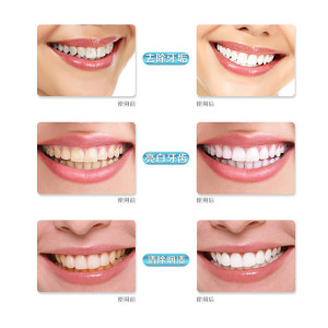 3ml 3D aluminum private label dental oral Teeth tooth Whitening Pen Tooth Gel Whitener Bleaching System