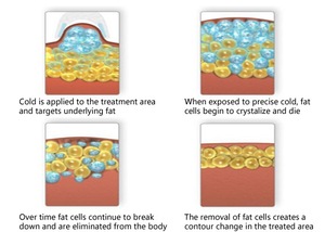 cold crio therapy fat reduction device cryogenic lipolysis equipment