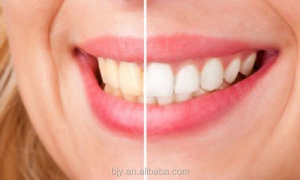 Dental teeth whitening gel syringe home use teeth whitener gel 35% hydrogen peroxide