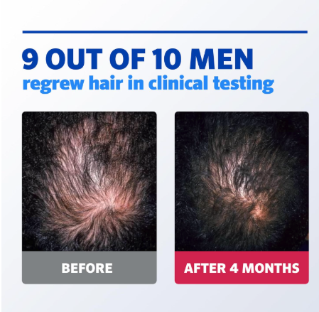 Men’s Hair Regrowth Foam 5% – Unscented Topical Aerosol, 3 Month Supply (3 x 2.11 oz)