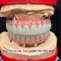 Dental Implant Lab  MYY Dental Lab China