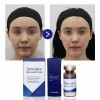 Devolux plla filler powder injection poly-l-lactic acid