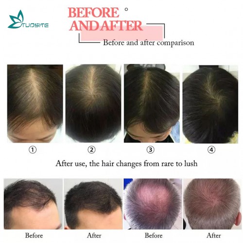 High Quality Hair Growth Laser/Diode Laser Hair Regrowth Machine/Hair Loss Treatment Machine