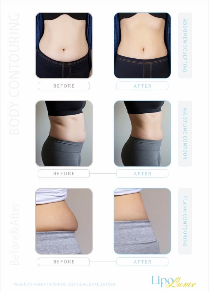 Botox,SKIN CARE , FACIAL, LipoLume — For Face &amp; Body Contouring