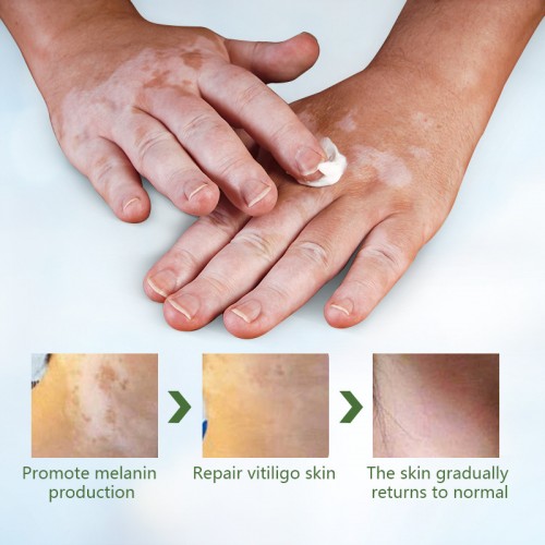 White Spot Ointment, Sweat Spot Pigmentation Patch, Skin Care Health Ointment