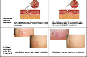 Portable device Vacuum cryolipolysis, fat freeze slimming cool tech, cryolipolysis machine with vacuum cavitation system