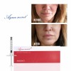 Aqua Secret hyaluronic injections acid lip filler injectable dermal filler