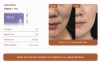Injectable PMMA + HA