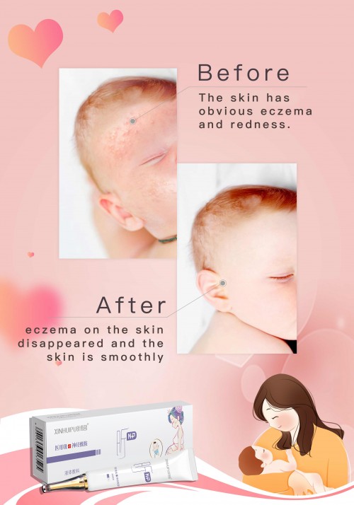 Pregnant and Maternal skin repair dressing assist the treatment of dry skin, red itching, eczema