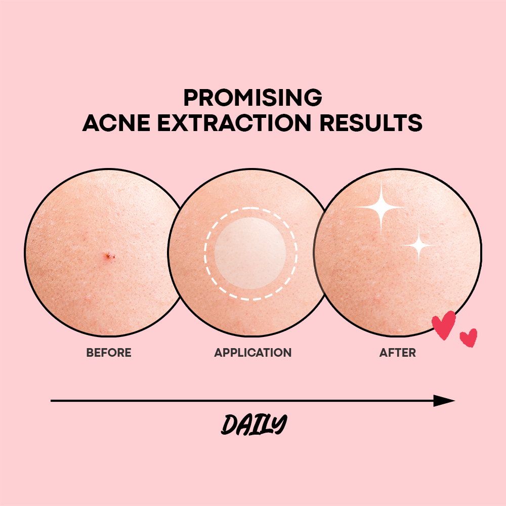 Acne Pimple Patch Hydrocolloid