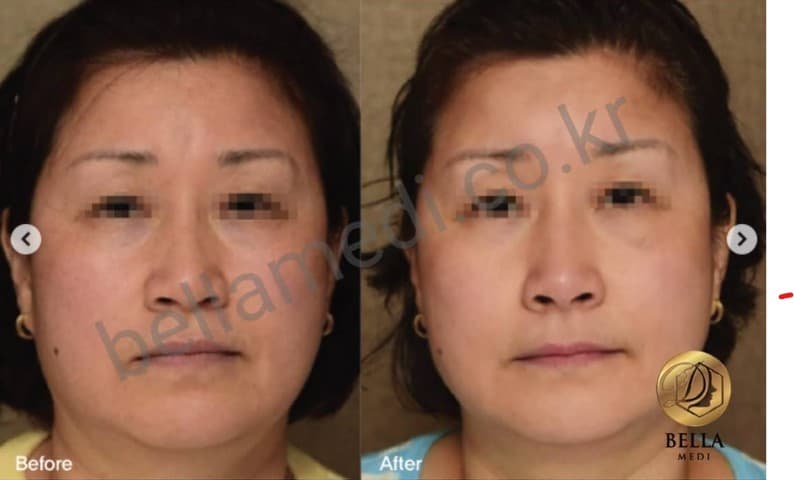 SOSUM PCL COLLAGEN SOLUTION