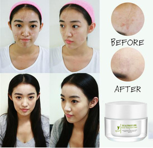 Natural Benzoyl Peroxide Fast Acne Removing 3 Days Acne Cream Treatment Acne Scar Removal Cream Gel for Skin Care