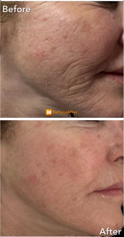 XO Derm - Exosomes 20 billion per vial