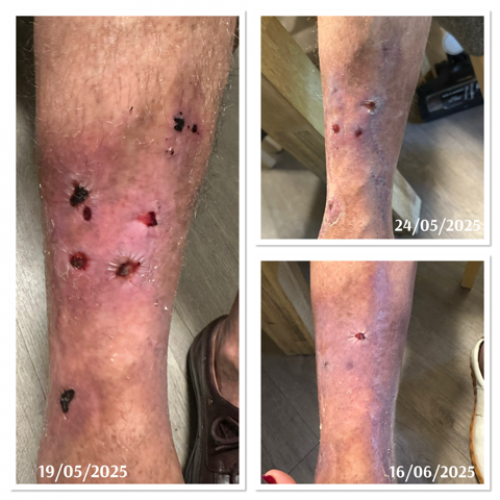 XO Derm - Exosomes 20 billion per vial