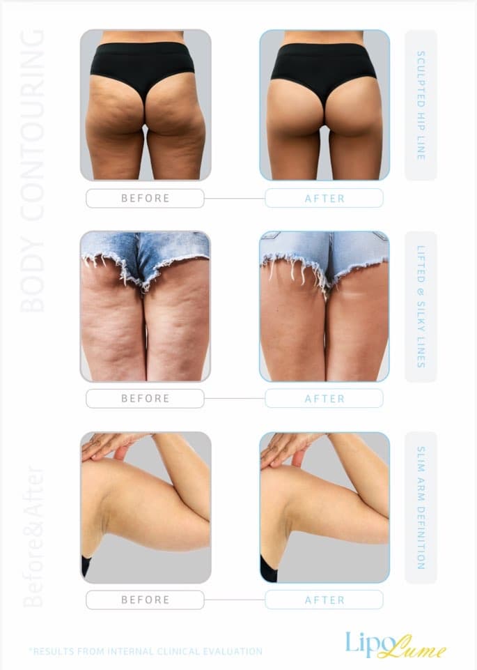 Botox,SKIN CARE , FACIAL, LipoLume — For Face &amp; Body Contouring