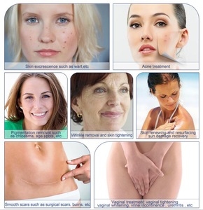 FDA approved 510k fractional co2 laser stretch marks warts removal skin tag treatment fda approved co2 laser