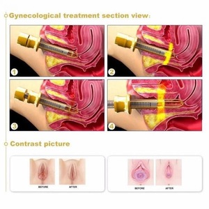 FDA approved 510k fractional co2 laser stretch marks warts removal skin tag treatment fda approved co2 laser