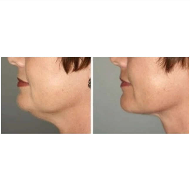 Liztox Best Seller For Face Body Frown Lines Anti Wrinkles Dermal