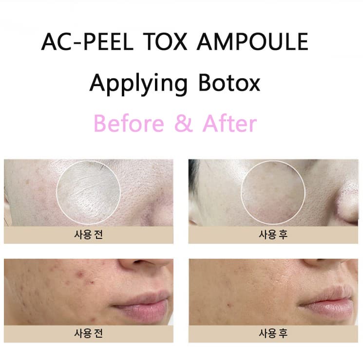 AC-PEEL TOX AMPOULE