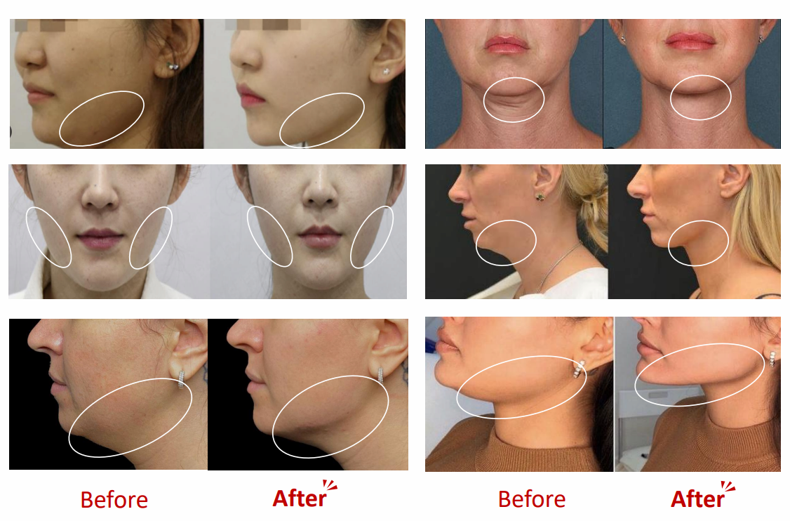 LIPO VELA - V Premium Lipolysis Solution with a Whitening &amp; Lifting Effect, Beautiful V-line