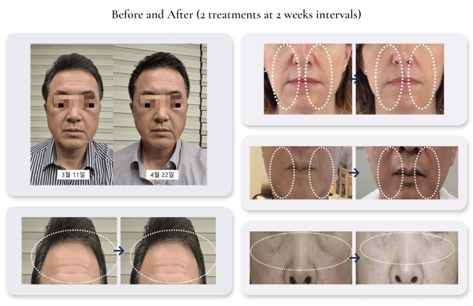 Made in South Korea High quality K Beauty Synerfill H-HA + L-HA + PDRN + PN Skin Booster