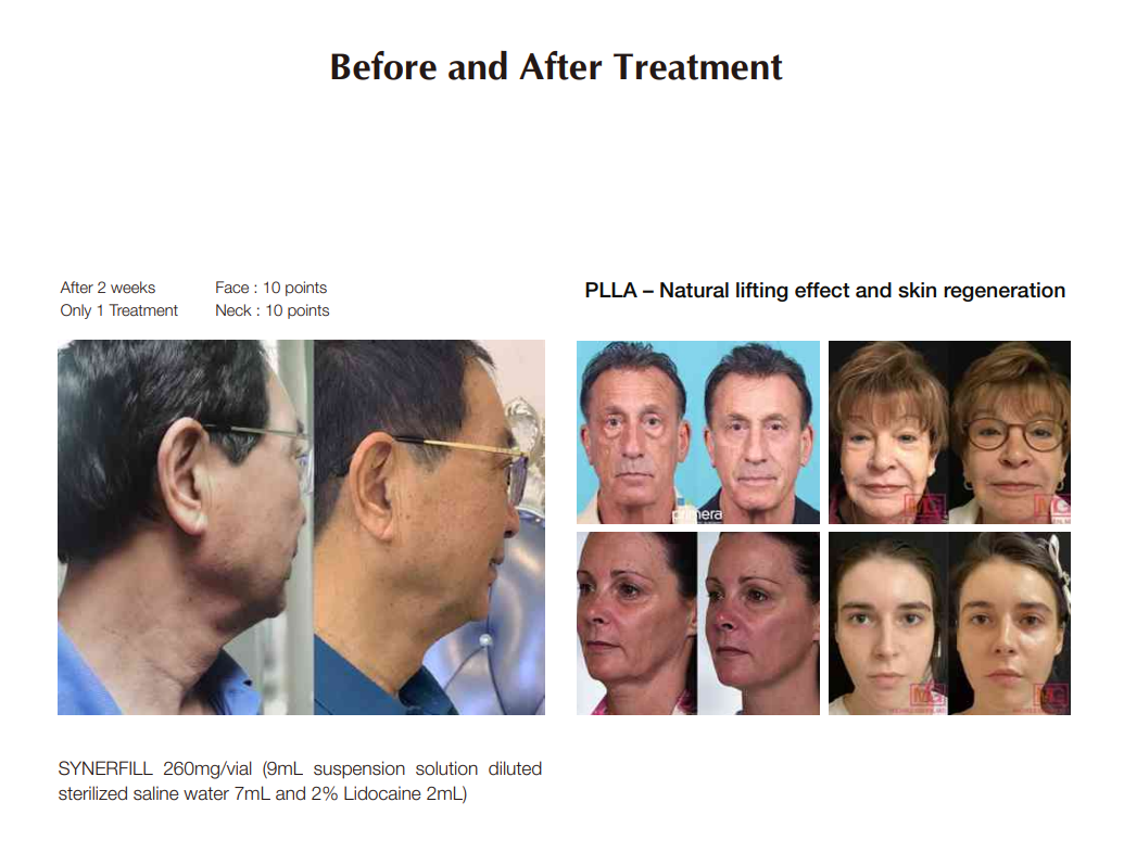 CPNP certified High quality premium PLLA(Poly-L-Lactic Acid) + H-HA+L-HA PLLA 200mg SYNERFILL Face