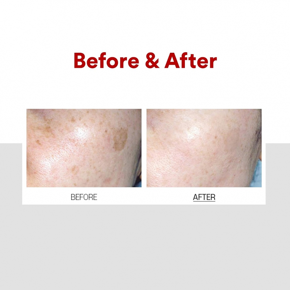 [MEDIPEEL] Melanon X Cream (renewal)