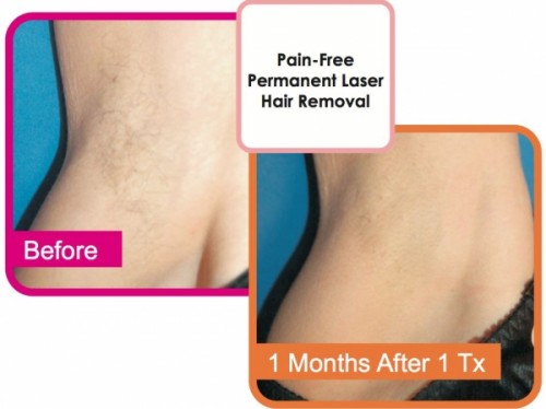 Diode laser hair removal bikini hair area