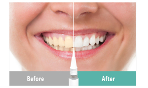 Popular teeth whitening bleaching gel teeth whitening pen with OEM packing