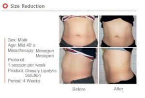 Hot Sale Otesaly Anti Cellulite Lipolytic Solution For Perfect Slim Body