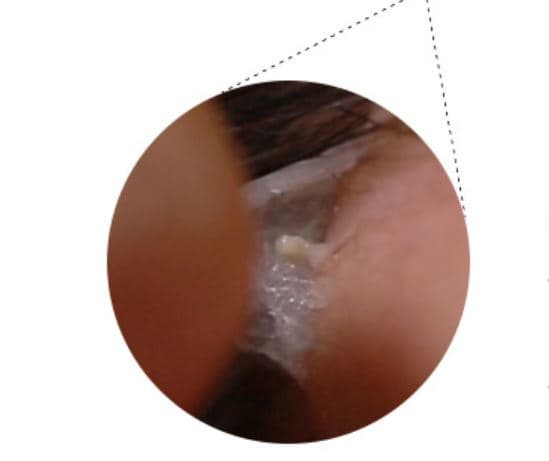 Korean Favorite like Acne Pimple Master Patch