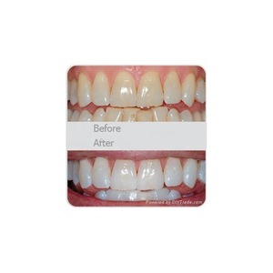 oral health equipment dental professional teeth whitening led light device
