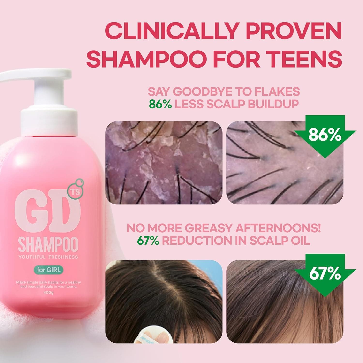 TS GD Shampoo for Teens  Korean Anti-Dandruff for Oily &amp; Itchy Scalp  Fruity Allergy-Free Scent