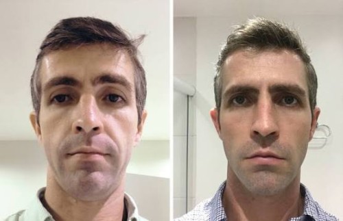Dermal fillers for sale