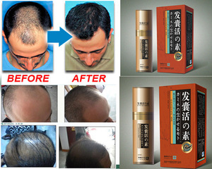 Naturally Hair Care Products/hair Loss Treatment Herbal Hair Growth Essence