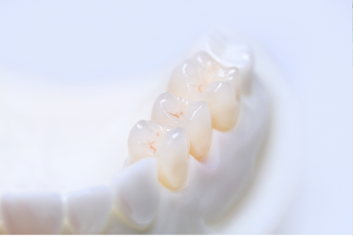 Full Contour Zirconia