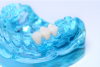Full Contour Zirconia