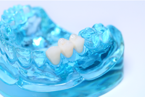 Full Contour Zirconia