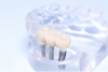 Full Contour Zirconia